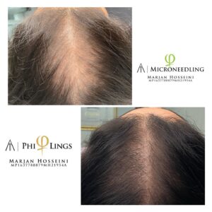 Does Microneedling Work for Hair Loss?