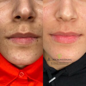 Combination of PhiIon and Microneedling for Even More Beautiful Results