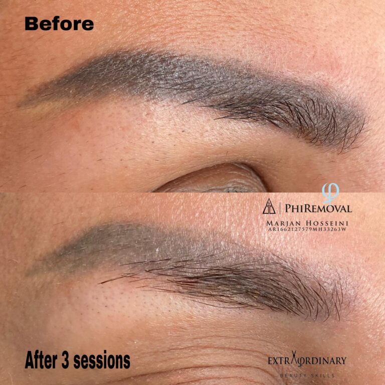 Warum man mindestens 3 Monate nach einer Laserbehandlung warten sollte, bevor man neues Permanent Make-up macht