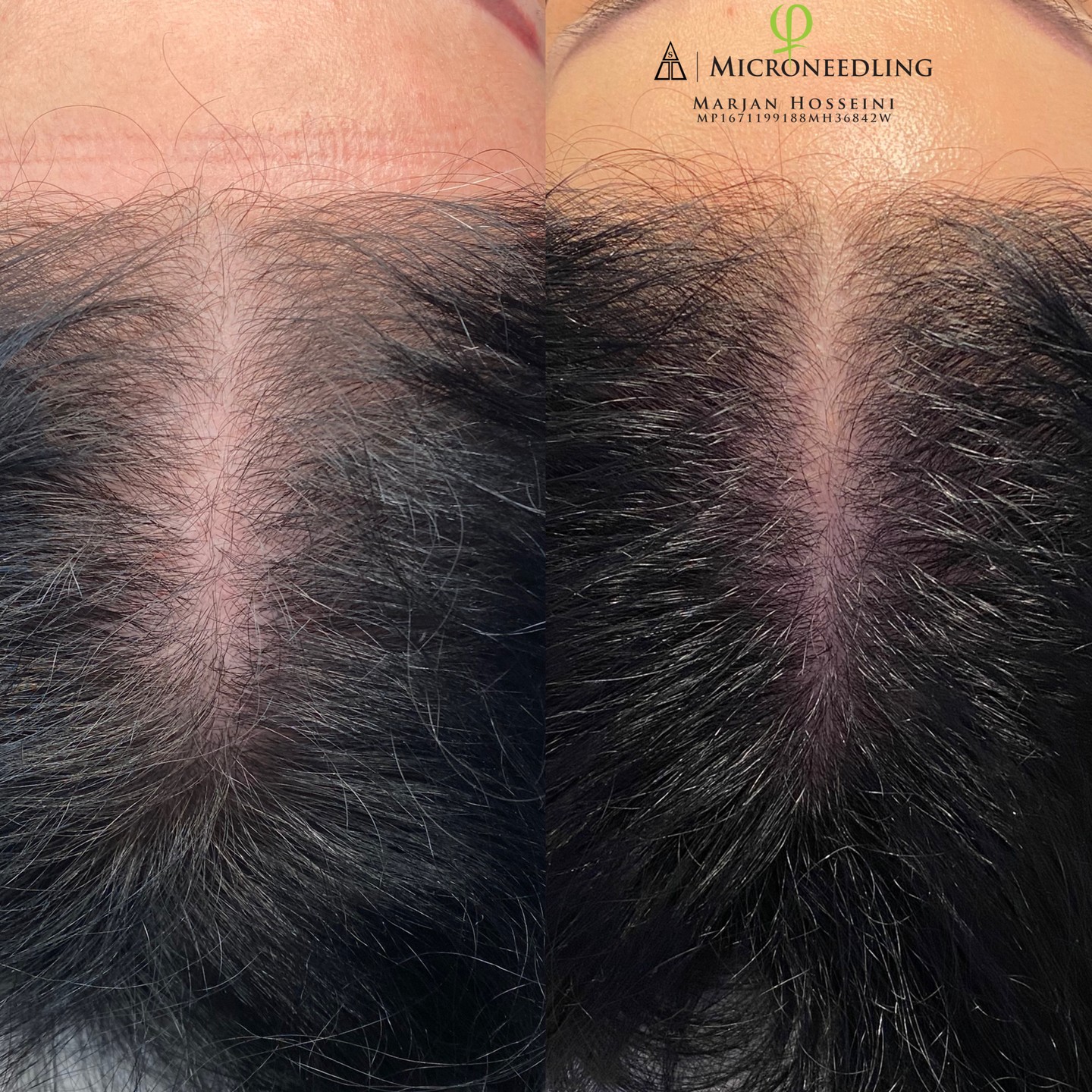 Anti-Haarausfall Microneedling