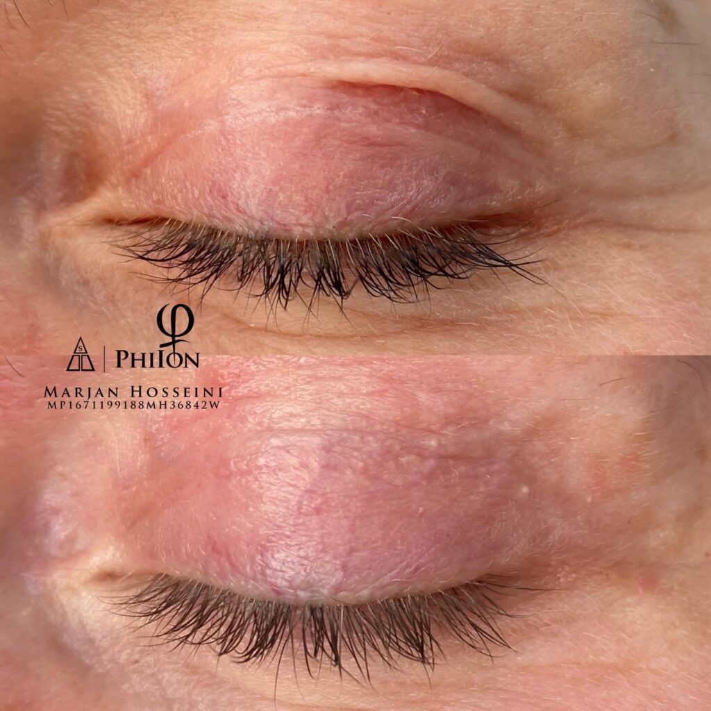 Der Unterschied zwischen PhiIon und anderen Plasma Pen Behandlungen