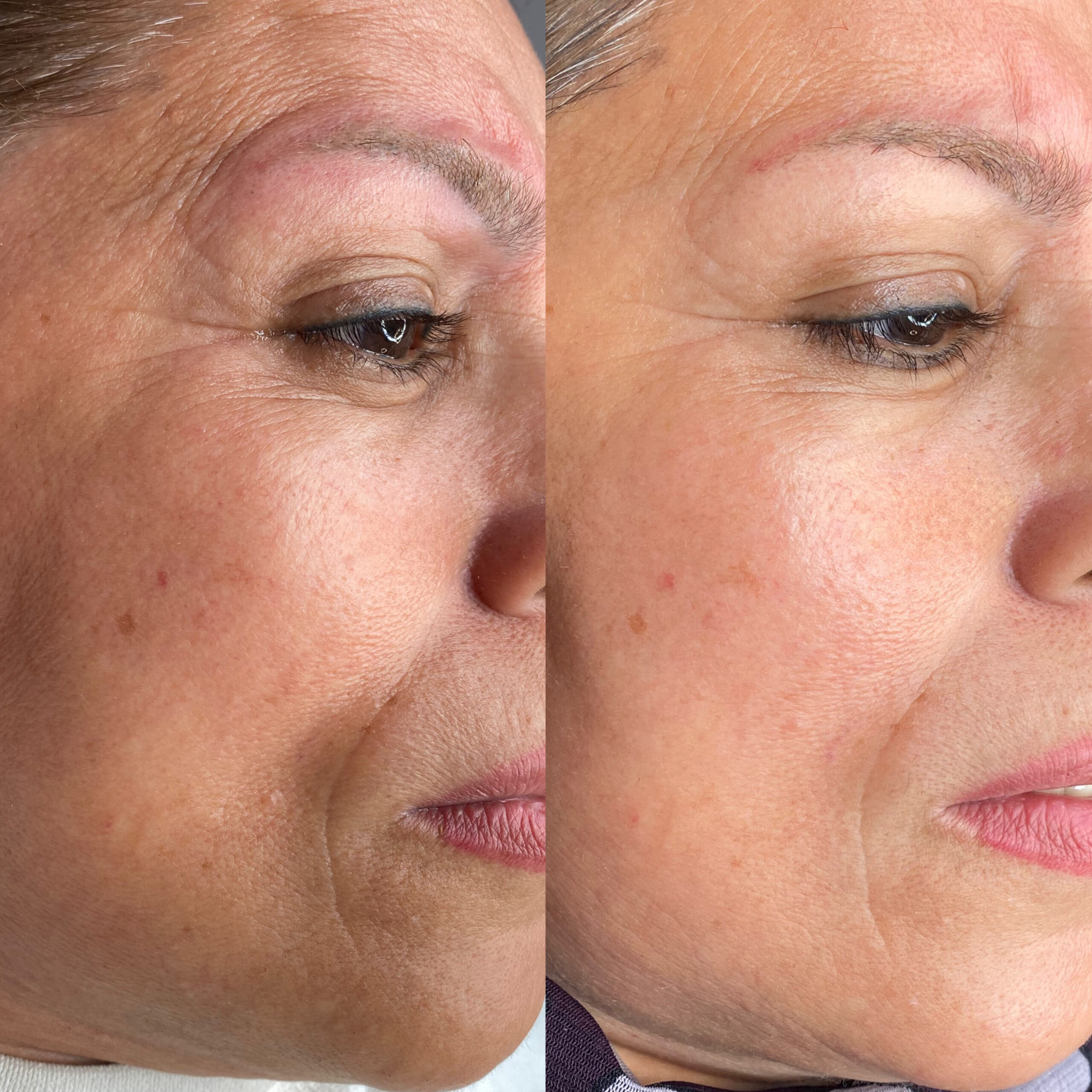 Microneedling