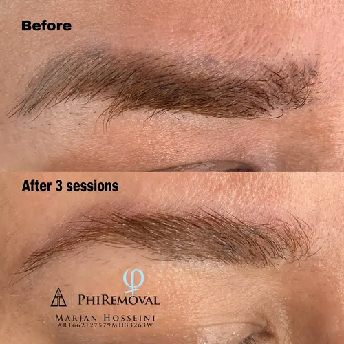 PhiRemoval PMU-Entfernung